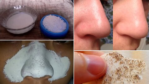 How to Remove Blackheads Naturally