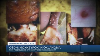 Probable case of monkeypox found in Oklahoma