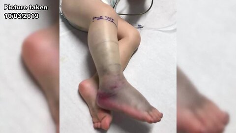 Toddler bitten by copperhead while playing in yard