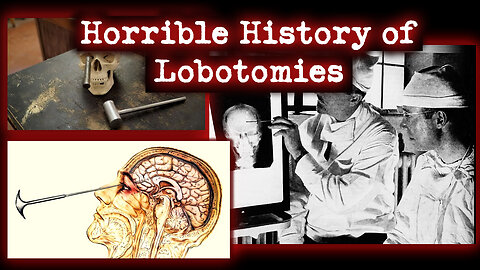The Lobotomy: A Medical Procedure Gone Wrong