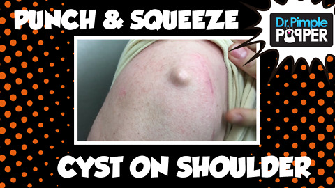 Epidermoid Cyst on the Shoulder Excised - The Size of a Marble