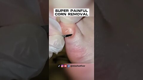 16 YEARS OLD SUPER PAINFUL CORN REMOVAL 2023 BY FOOT DOCTOR MISS FOOT FIXER