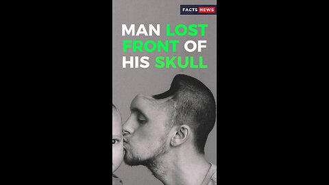 Man lost front of his skull #factsnews #shorts