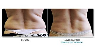 Hollywood Body Laser- "Take It Further" Coolsculpting