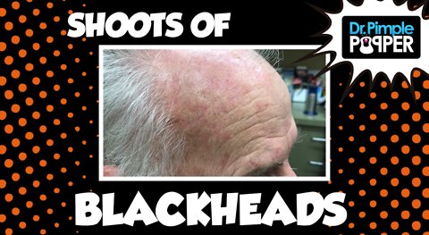 Shoots of Blackheads for the Love of His Wife!