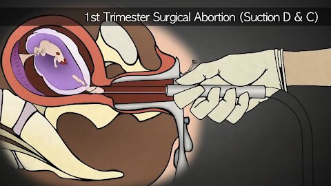 1st Trimester Medical Abortion Using Abortion Pills | Former Abortionist Turns Pro-Life