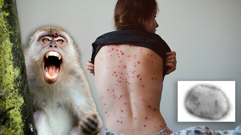 Monkey Pox Do NOT believe the lie !