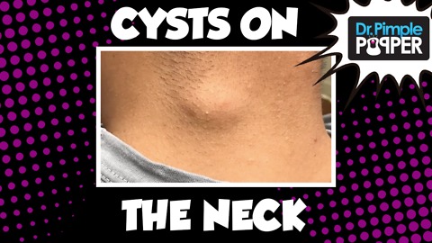 A Cyst we Can't Neck-lect...