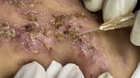Blackheads & Milia, Big Acne Blackheads Extraction Removal Pimple Popping!