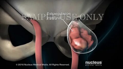 Reparación laparoscópica de hernia inguinal