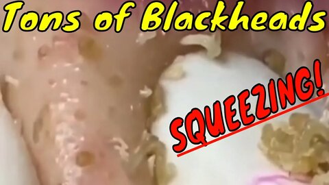 Tons of blackheads squeezing! 😳 #blackheadremoval #blackhead #blackheads #blackheadsqueezing #fyp