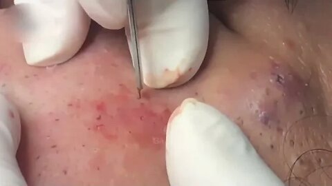 Removal / extraction of blackheads and pimples. Satisfying videos