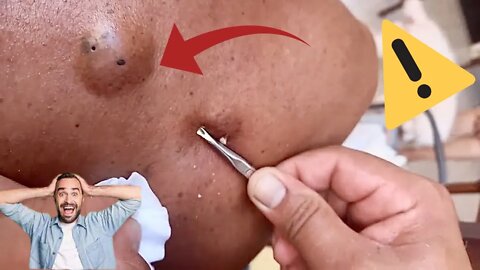 remoção de espinhas E CRAVOS PODRES Giant Pimple eliminación de espinillas