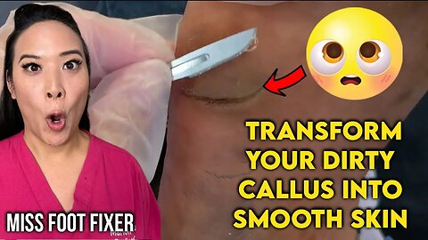 Revolutionary Callus Removal: Transform Your Dirty Callus into Smooth Skin By Famous Podiatrist