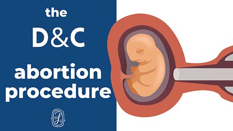 About D&C Abortion (Dilation and Curettage)