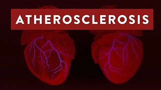 The Truth About Atherosclerosis