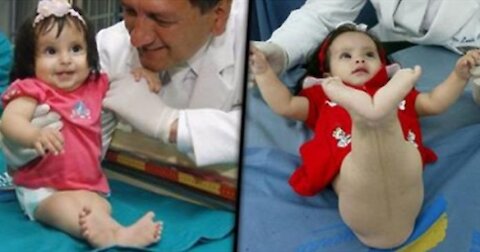 The Inspirational Story Of Baby Born With Mermaid Tail