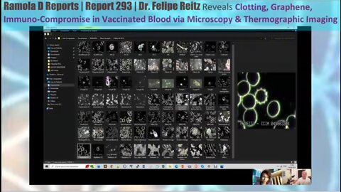 Dr. Felipe Reitz reveals clotting, graphene, immuno-comprimise in vaccinated blood