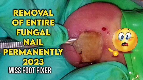 REMOVAL OF ENTIRE FUNGAL NAIL PERMANENTLY 2023 BY FAMOUS PODIATRIST MISS FOOT FIXER