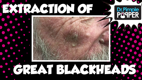 Dr Pimple Popper: Blackheads or Sebaceous Filaments on the Nose? Extractions