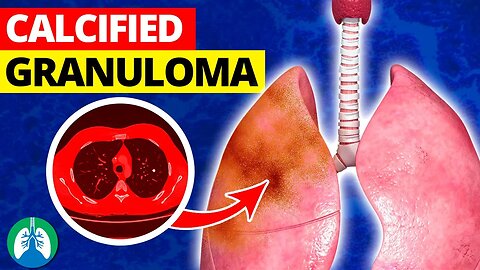 What is a Calcified Granuloma in the Lungs? 🫁