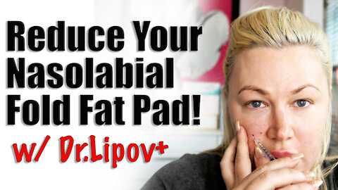 Get rid of your Nasolabial Folds with Dr.Lipo+V | Code Jessica10 saves you $$$