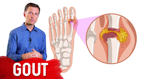 The 7 Natural Remedies for Gout