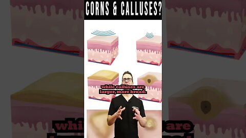 Foot CORNS & CALLUSES: How To Get Rid Of Them For Good!