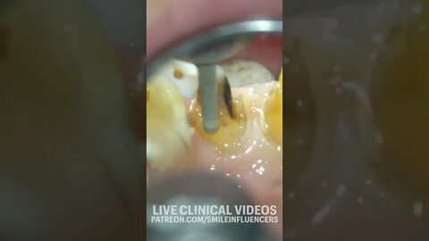 Can We Save This Tooth?