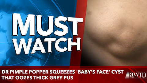 Dr Pimple Popper squeezes 'baby's face' cyst that oozes thick grey pus