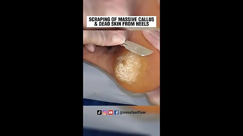 SCRAPING OF MASSIVE CALLUS & DEAD SKIN FROM HEELS 2023 BY FOOT DOCTOR MISS FOOT FIXER