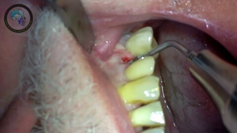 Wisdom Tooth Removal, Wisdom Tooth Extraction #04