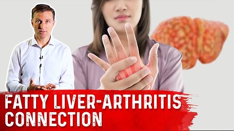 Why Does a Fatty Liver Trigger Arthritis? Fatty Liver Inflammation & Joint Inflammation – Dr.Berg