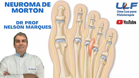 Neuroma de Morton - Dr. Prof. Nelson Marques