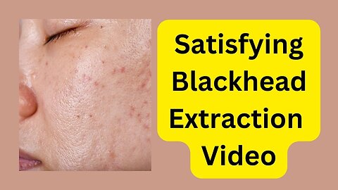 Satisfying Blackhead Extraction: Watch This Amazing Video!