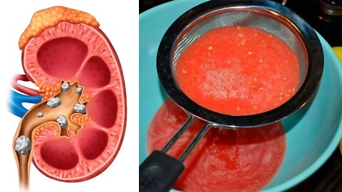 How To Cleanse & Detox Your Kidneys Naturally