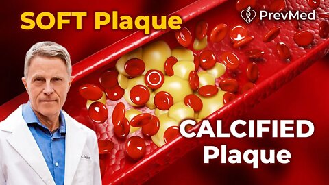 The Difference between Soft plaque and Calcified plaque