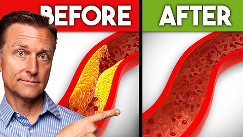 Best Nutrients to Remove Plaque from Arteries