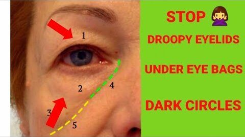 How to fix DROOPY EYELIDS Under eye bags and dark circles massage