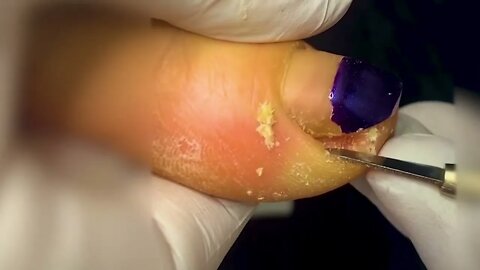 Manicure Unclogging the toenail Solve your problem #13 | 2022 Video