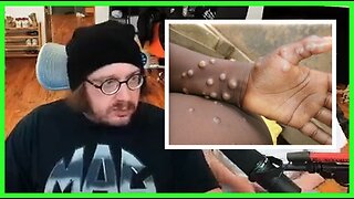 Sam Hyde on Monkeypox