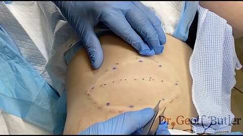 Removal 20 year old Lipoma on Abdomen