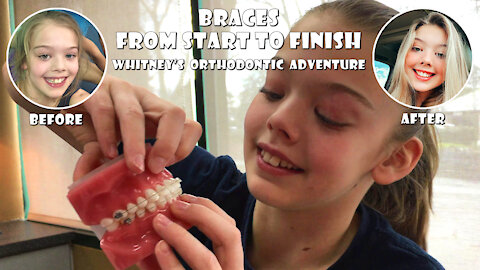 Braces Start to Finish Whitney Bjerken's Orthodontic Adventure
