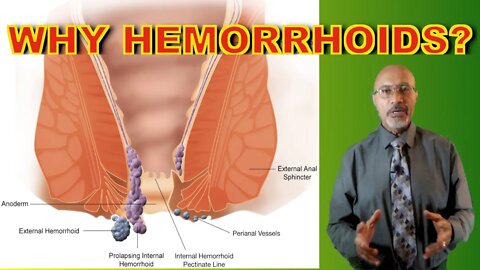 Hemorrhoids Causes And Prevention