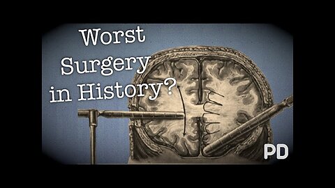 Lobotomy - The worst surgery in history? (Documentary)