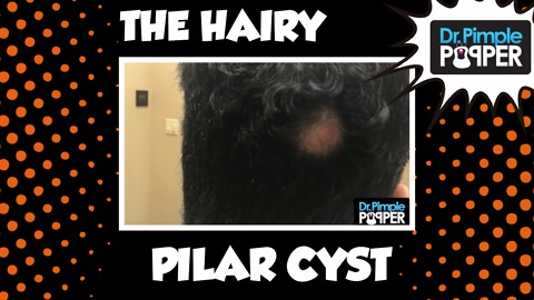 A Very HAIRY Removal on THIS Scalp Cyst!