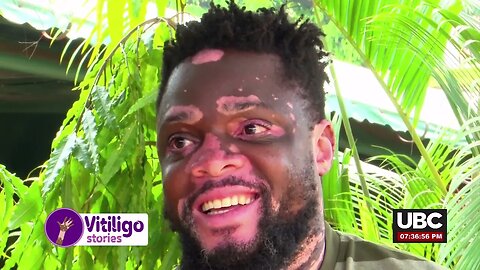 VITILIGO STORIES "A STORY OF VITILIGO KING" WITH SOPHIE MATOVU