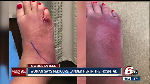 Woman claims she got a serious foot infection after pedicure at a Noblesville spa