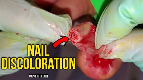 Get Rid Of Nail Discoloration *** Curved Nail Treatment *** Foot Doctor Miss Foot Fixer