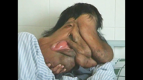 Chinese 'Elephant Man'